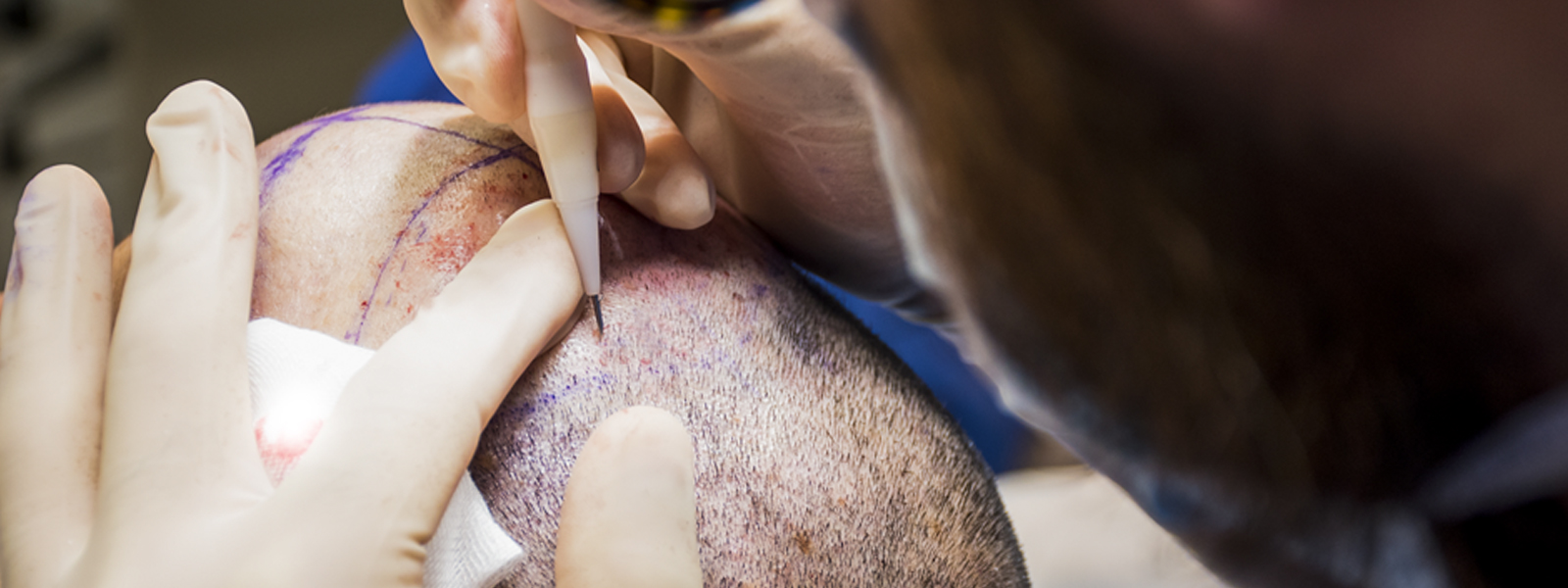 Max Biagi trapianto capelli