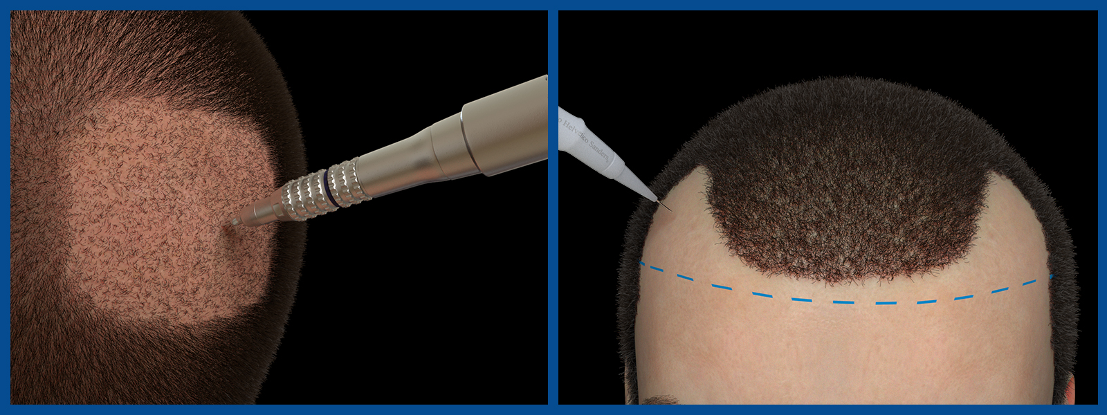 Trapianto capelli bracken