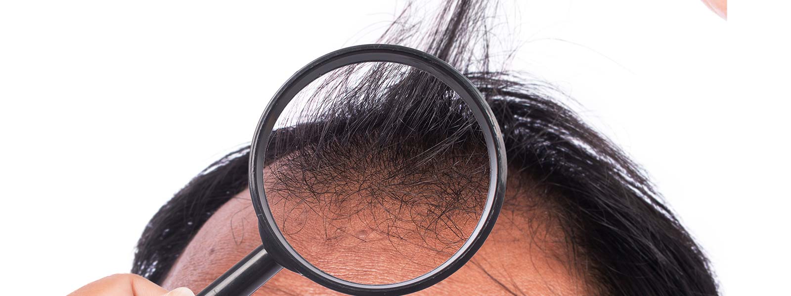 trapianto capelli elthon john