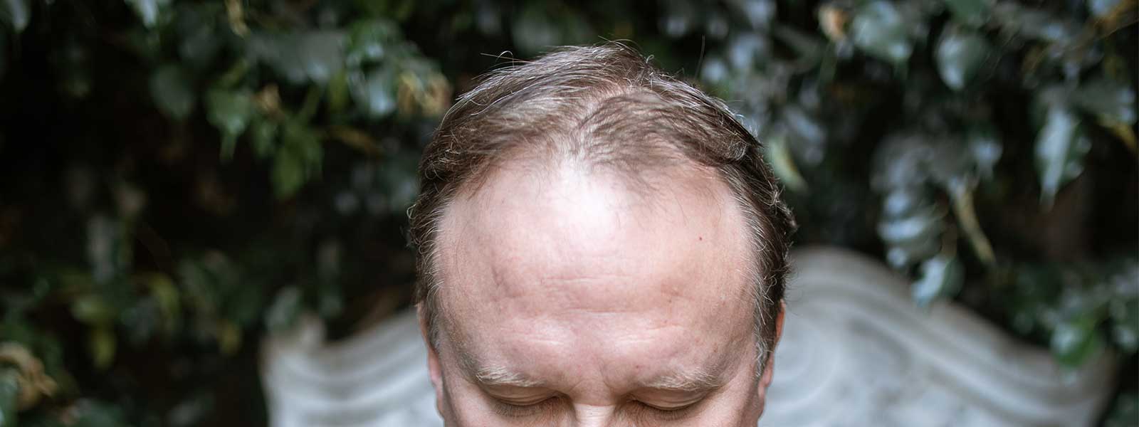 alopecia