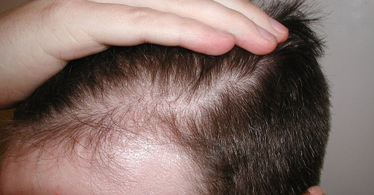 I Capelli Diradati Possono Ricrescere?