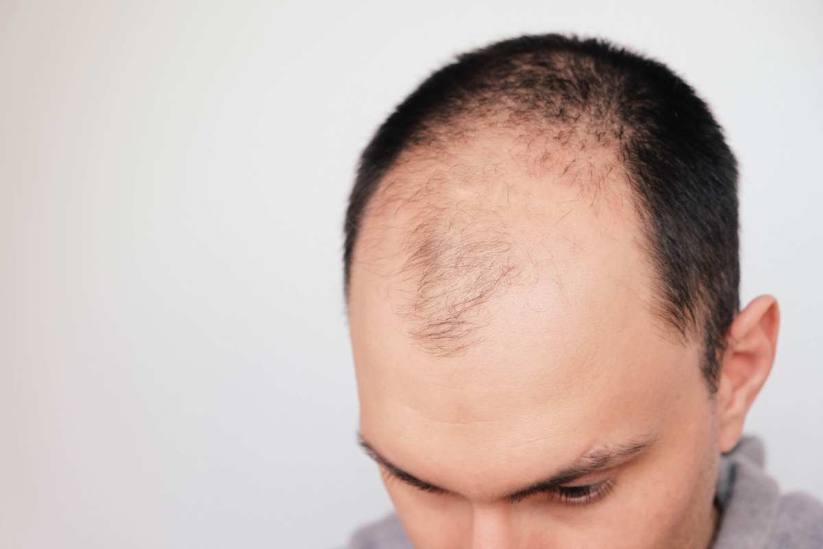 alopecia frontoparietale
