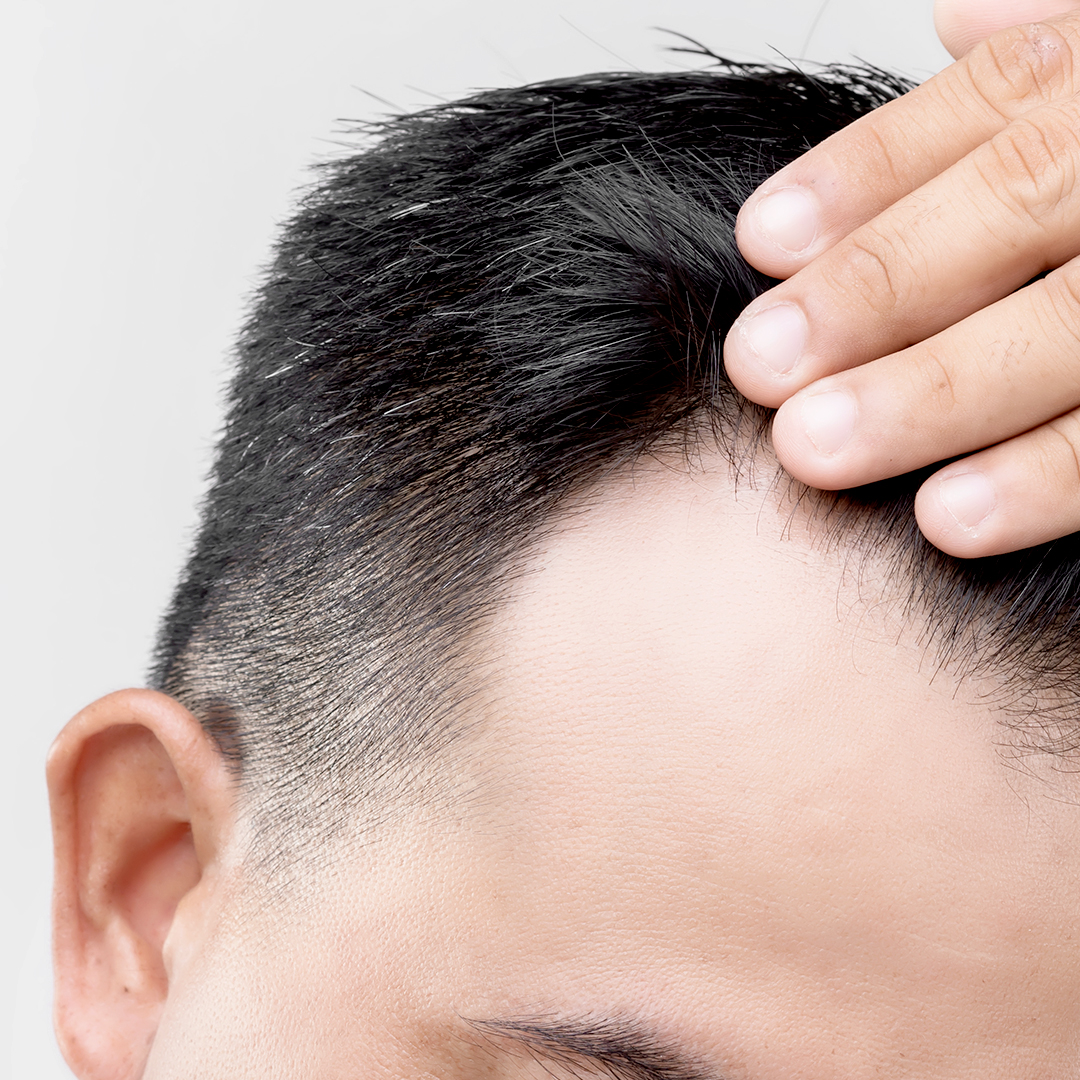 Alopecia a evoluzione lenta