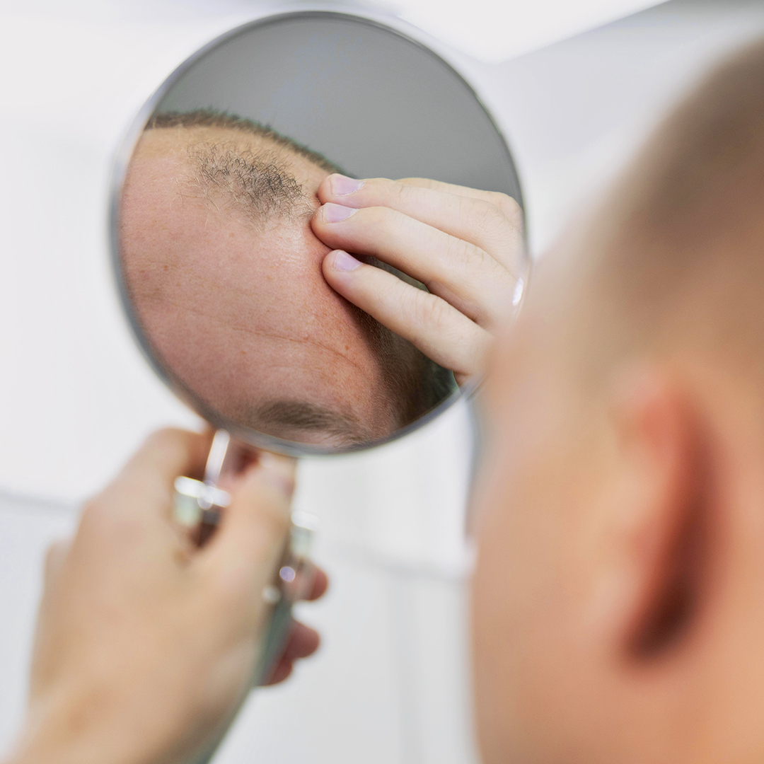 Alopecia ad evoluzione rapida