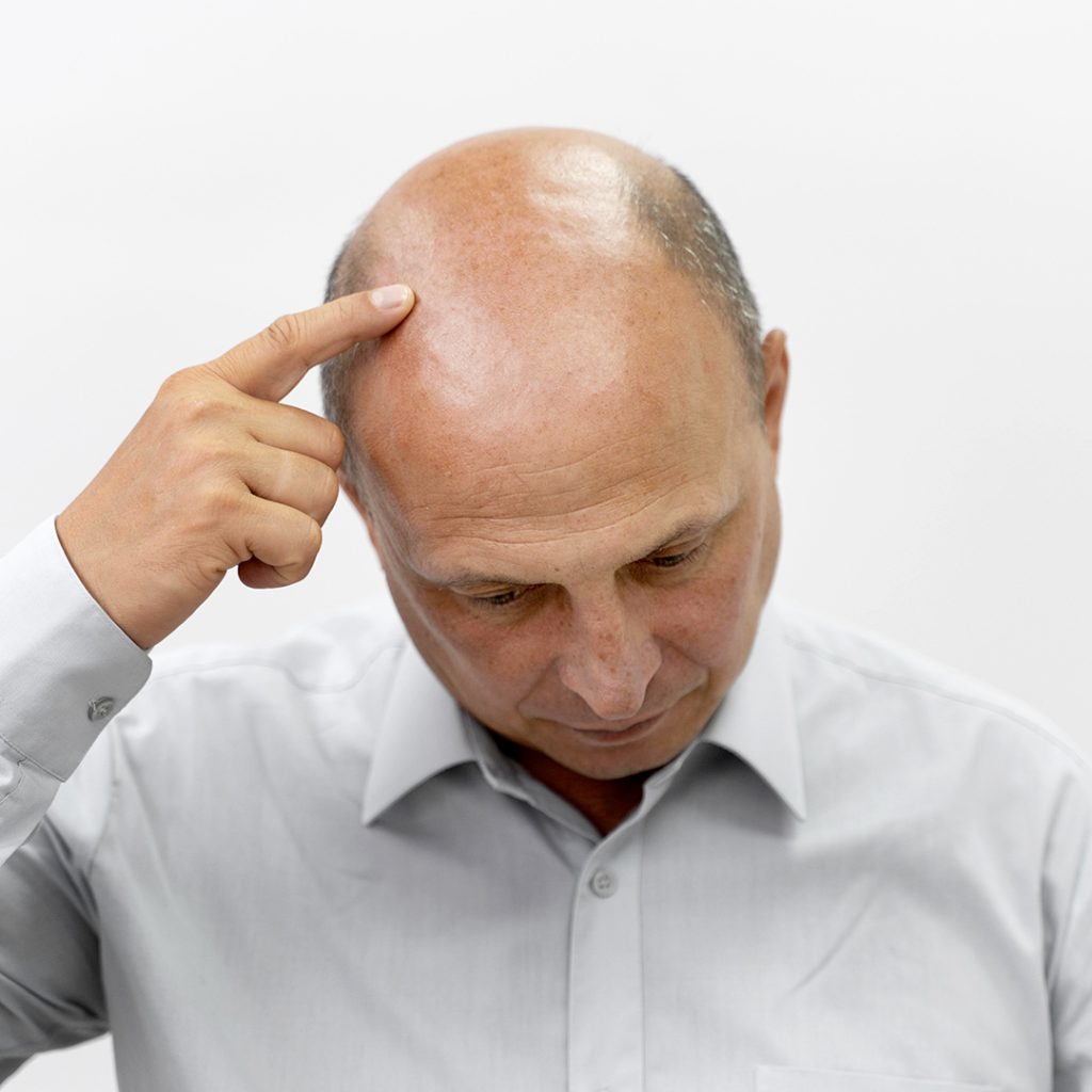 Alopecia androgenetica uomo