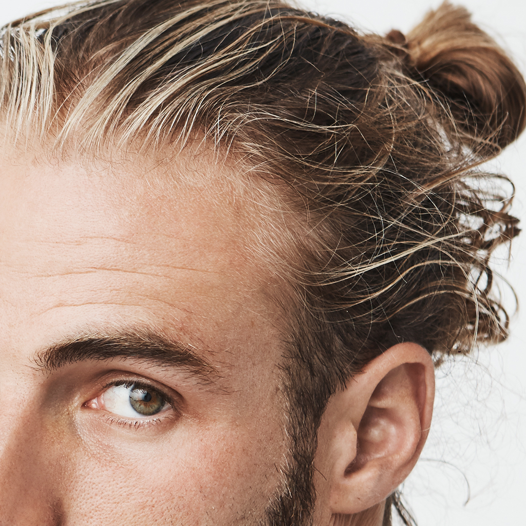 Alopecia da trazione cause caduta uomo