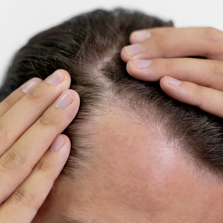 Accorciamento della fase di crescita del capello con un distacco prematuro del fusto dal follicolo