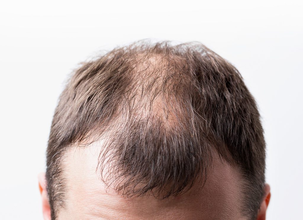 Cause caduta capelli nell'uomo