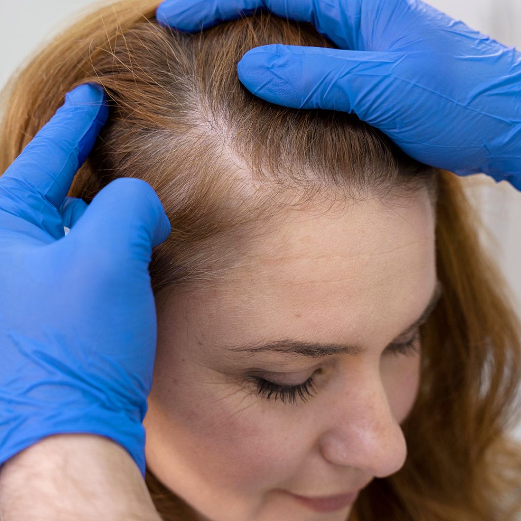 Tricotillomania donna