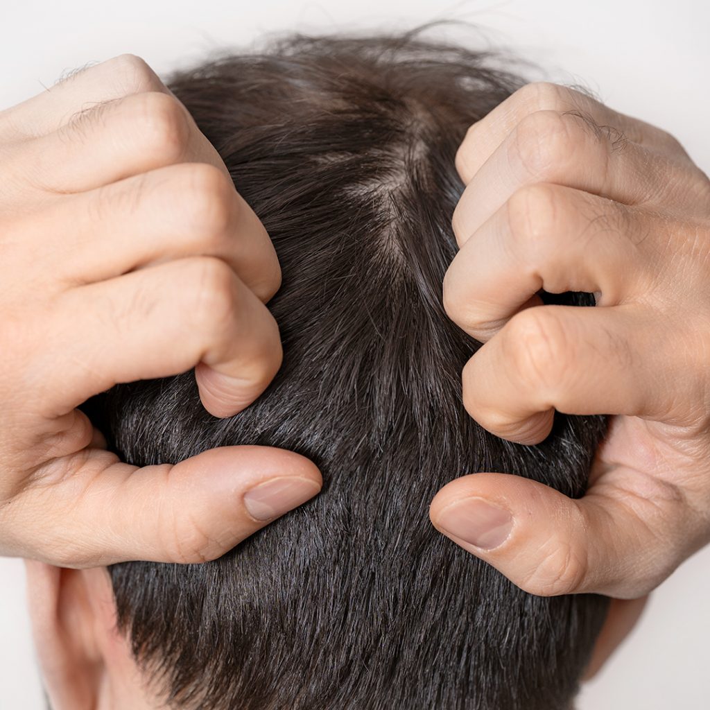 Tricotillomania uomo