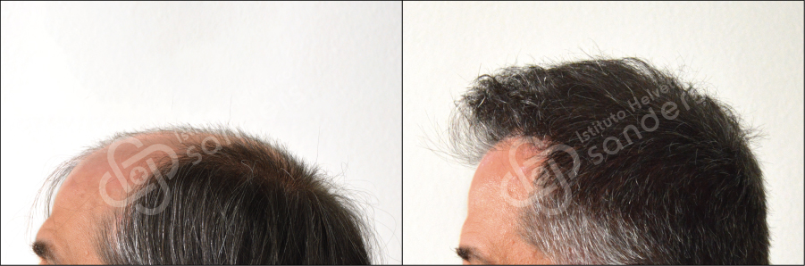 Zona laterale risultati trapianto 13