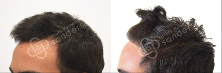 Zona laterale risultati trapianto 14