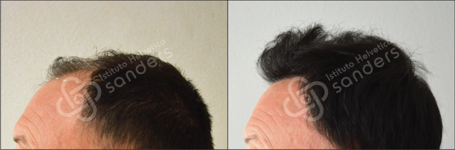 Zona laterale risultati trapianto 15