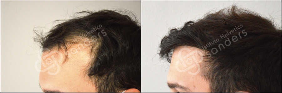 Zona laterale risultati trapianto 16