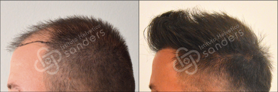 Zona laterale risultati trapianto 17