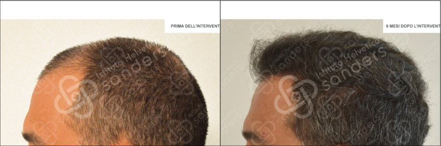 Zona laterale risultati trapianto 18