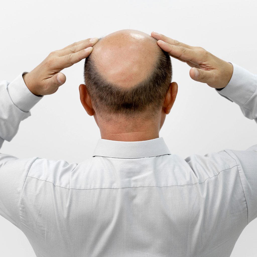 Alopecia androgenetica maschile