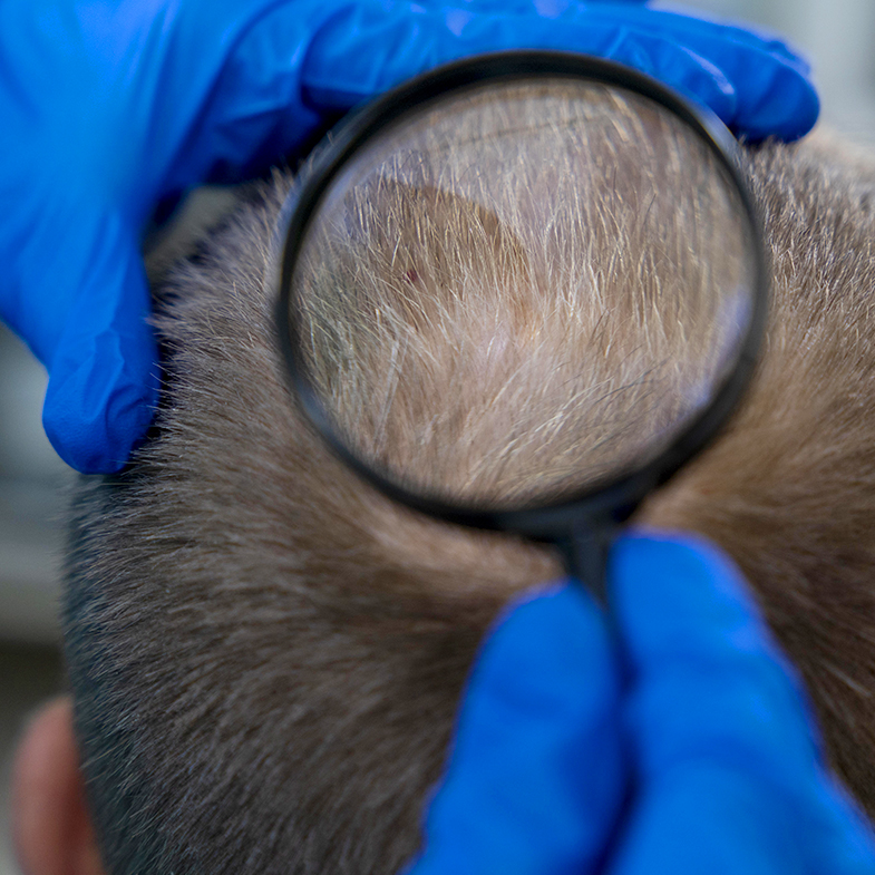 Caduta dei capelli nell’uomo come agire