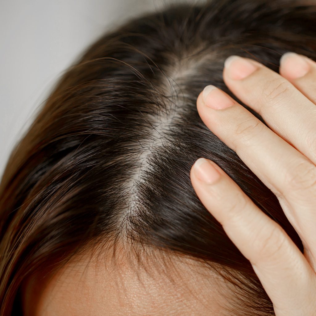 La calvizie femminile