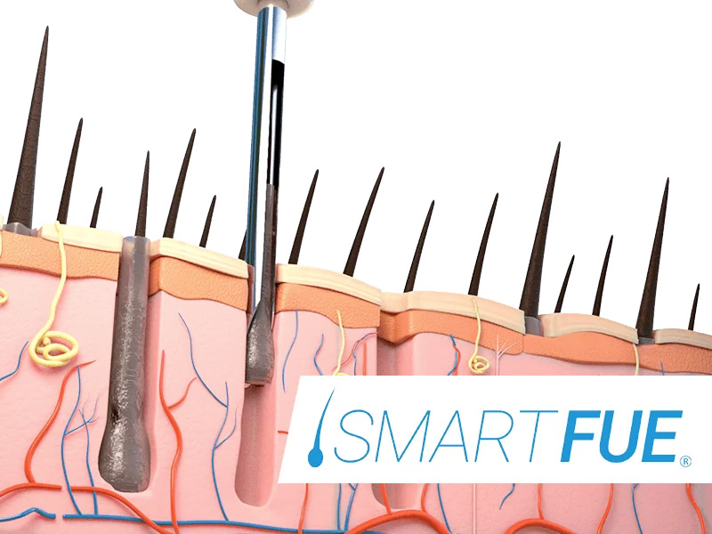 calvizie precoce soluzioni smart fue