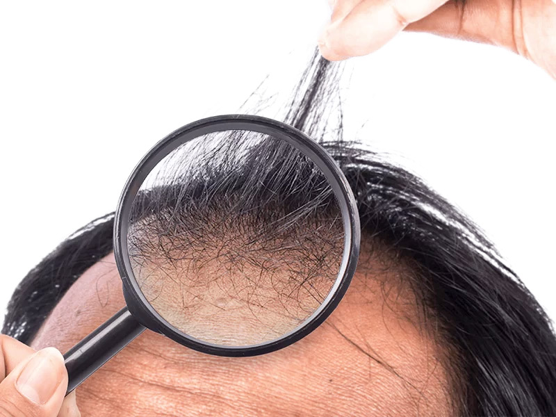 cause caduta capelli alopecia areata come accorgersene