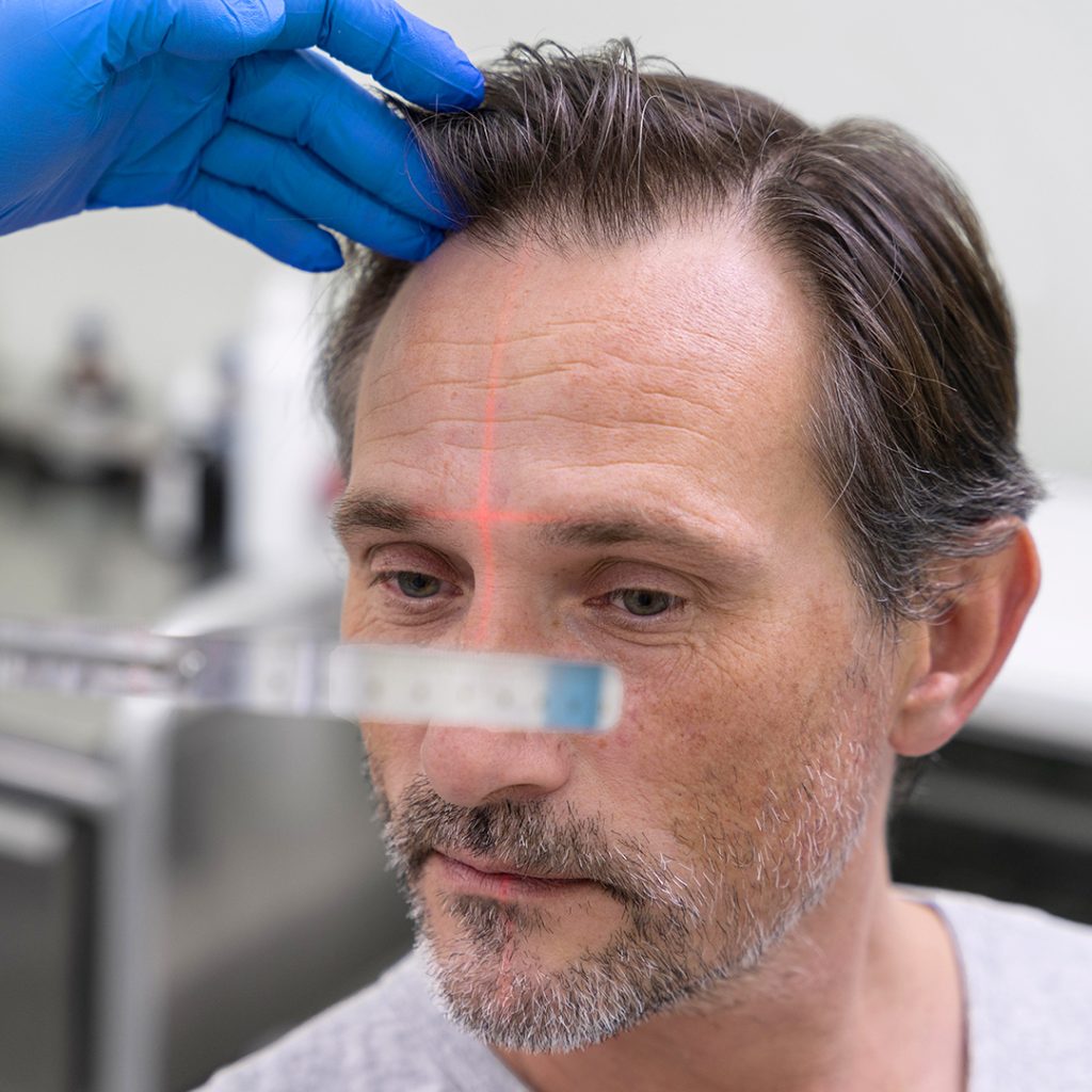 Vantaggi del sistema del trapianto capelli