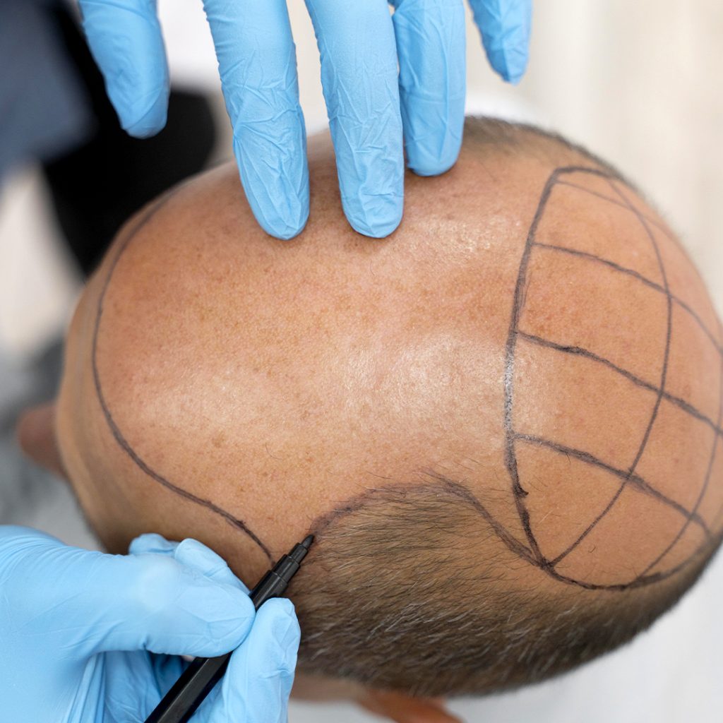 40 anni di esperienza nel trattamento della calvizie e di tutte le problematiche del cuoio capelluto