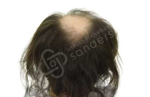 michele pre trapianto