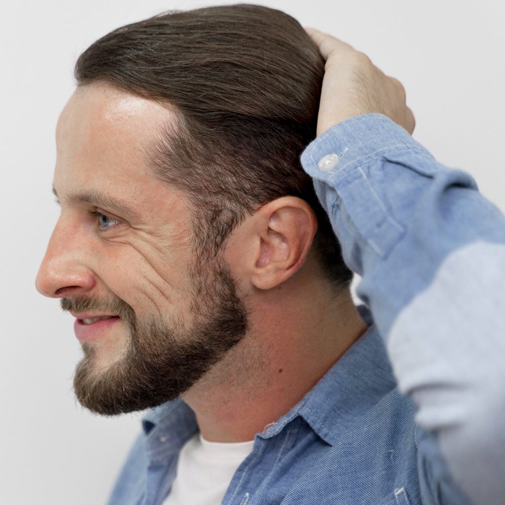 I benefici dell’autotrapianto di capelli