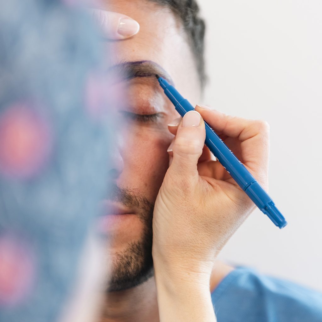 Come funziona trapianto sopracciglia disegno progetto