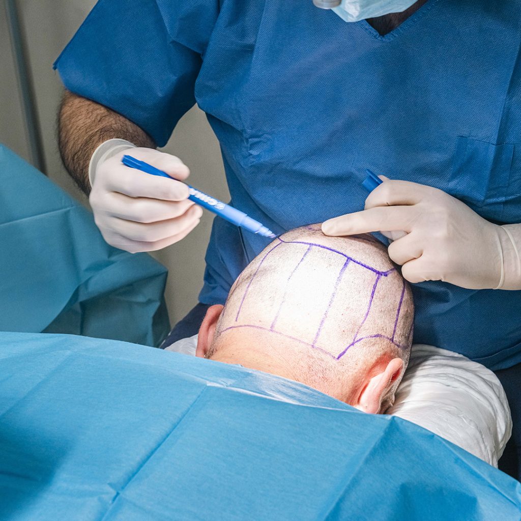 Trapianto di capelli in Italia: l’esperienza dei migliori chirurghi