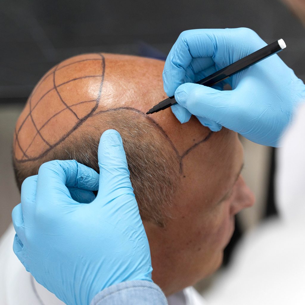 Protocolli specifici per ogni tipo di calvizie