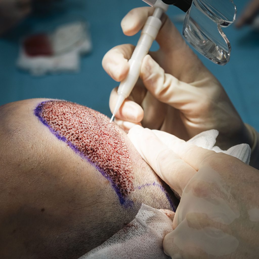 Trapianto capelli smart fue risultati naturali e graduali