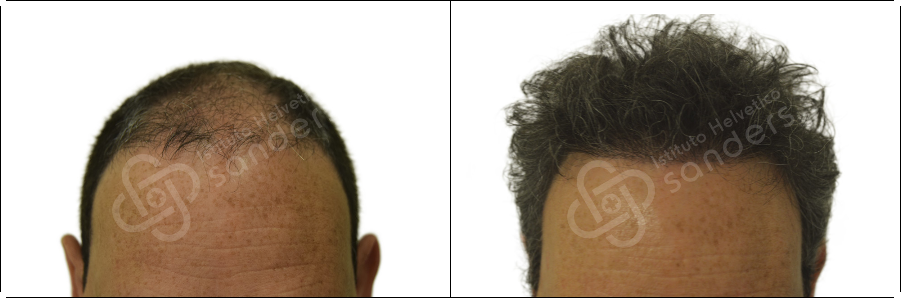 Risultati prima dopo trapianto zona frontale Alfonso Esposito