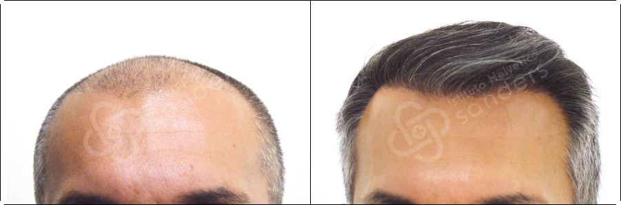 Risultati prima dopo trapianto zona frontale Benedetto Caputo