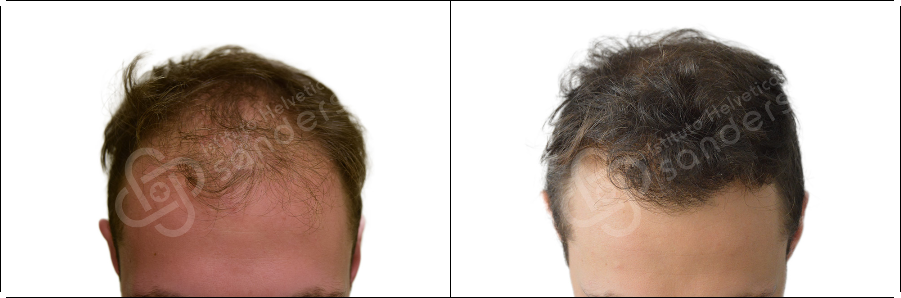 Risultati prima dopo trapianto zona David Cambiuzzi