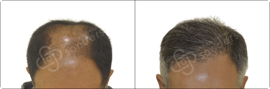 Risultati prima dopo trapianto zona Federico Iacono