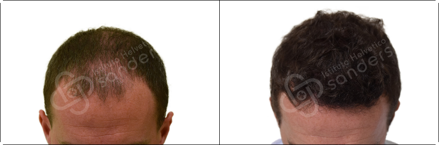 Risultati prima dopo trapianto zona Simone Tombolesi