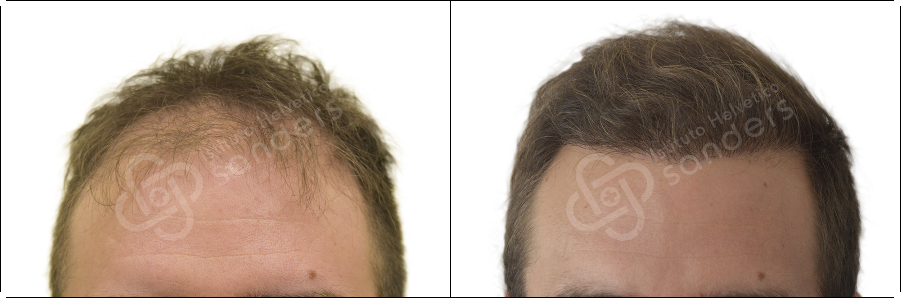 Risultati prima dopo trapianto zona Stefano