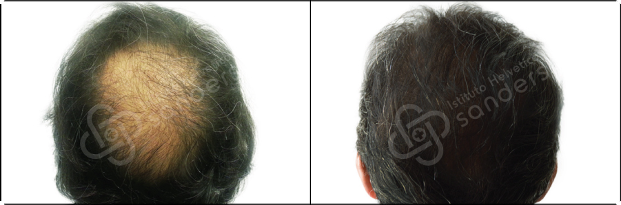 Risultati prima dopo trapianto zona vertice Alberto Calandri