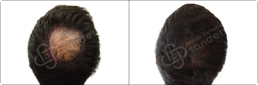 Risultati prima dopo trapianto zona vertice Lorenzo Terraneo