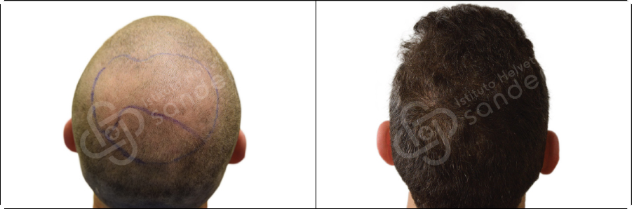 Risultati prima dopo trapianto zona vertice Marco Banali