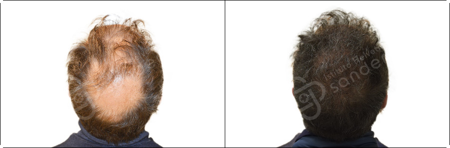 Risultati prima dopo trapianto zona vertice Marco Volpi