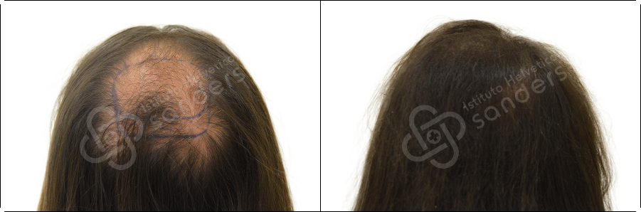 Risultati prima dopo trapianto zona vertice Stefano Petrucci