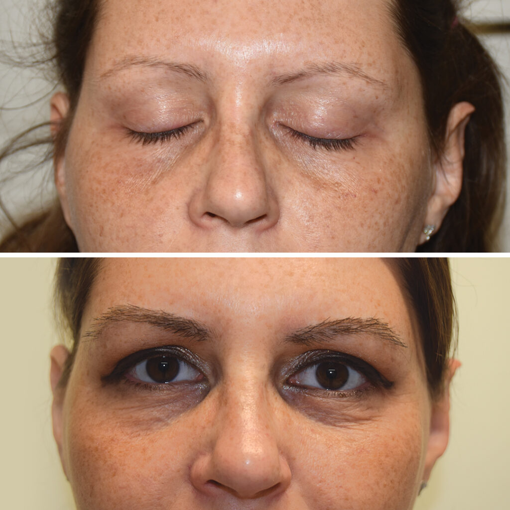 Prima e dopo trapianto sopracciglia