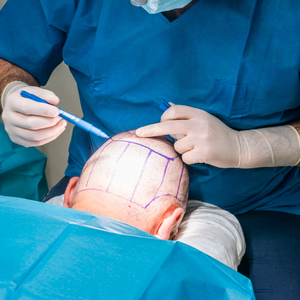 Scopri tecniche, procedura chirurgica, raccomandazioni e consigli utili sul trapianto di capelli.