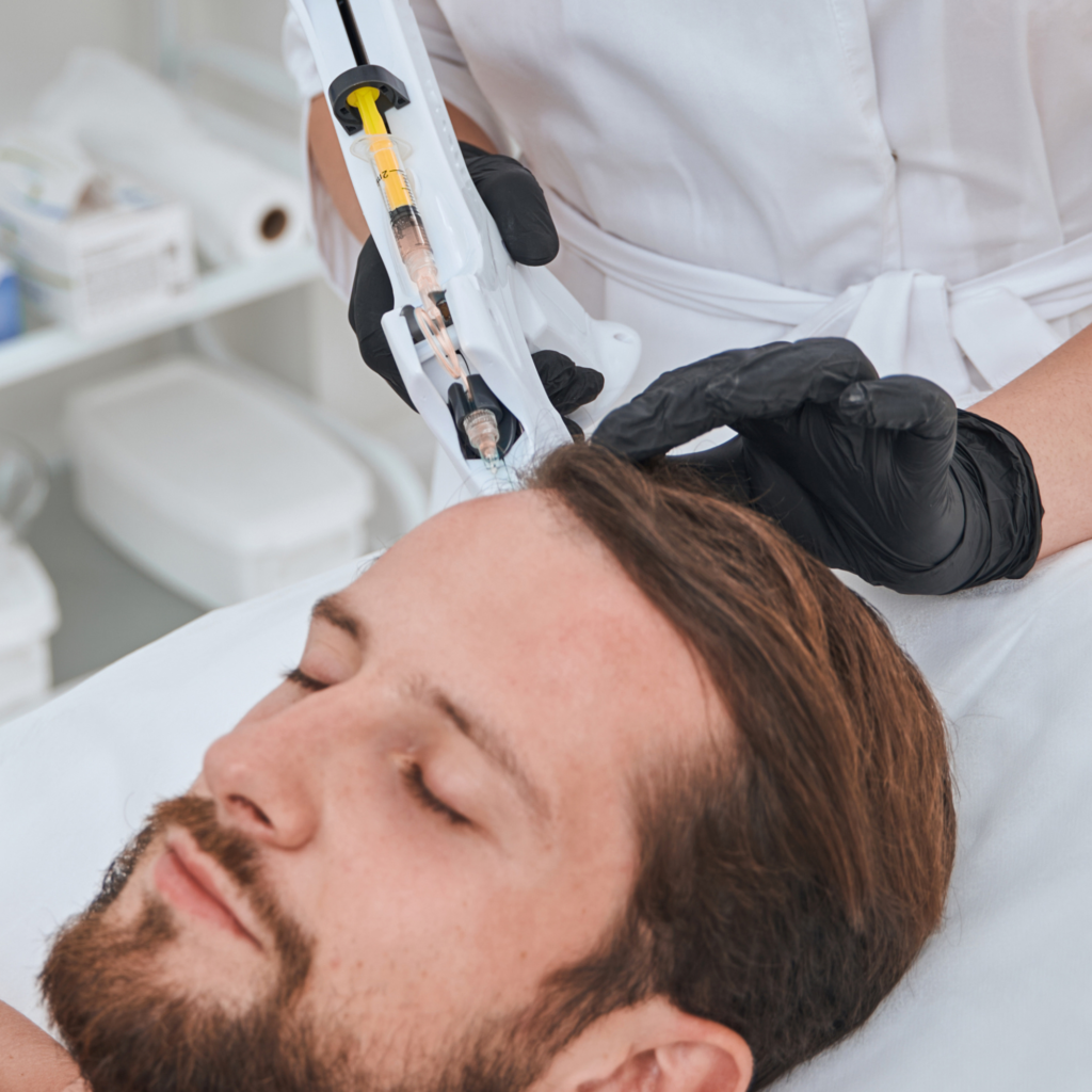 Trattamenti medicina rigenerativa tricologica: mesoterapia per capelli