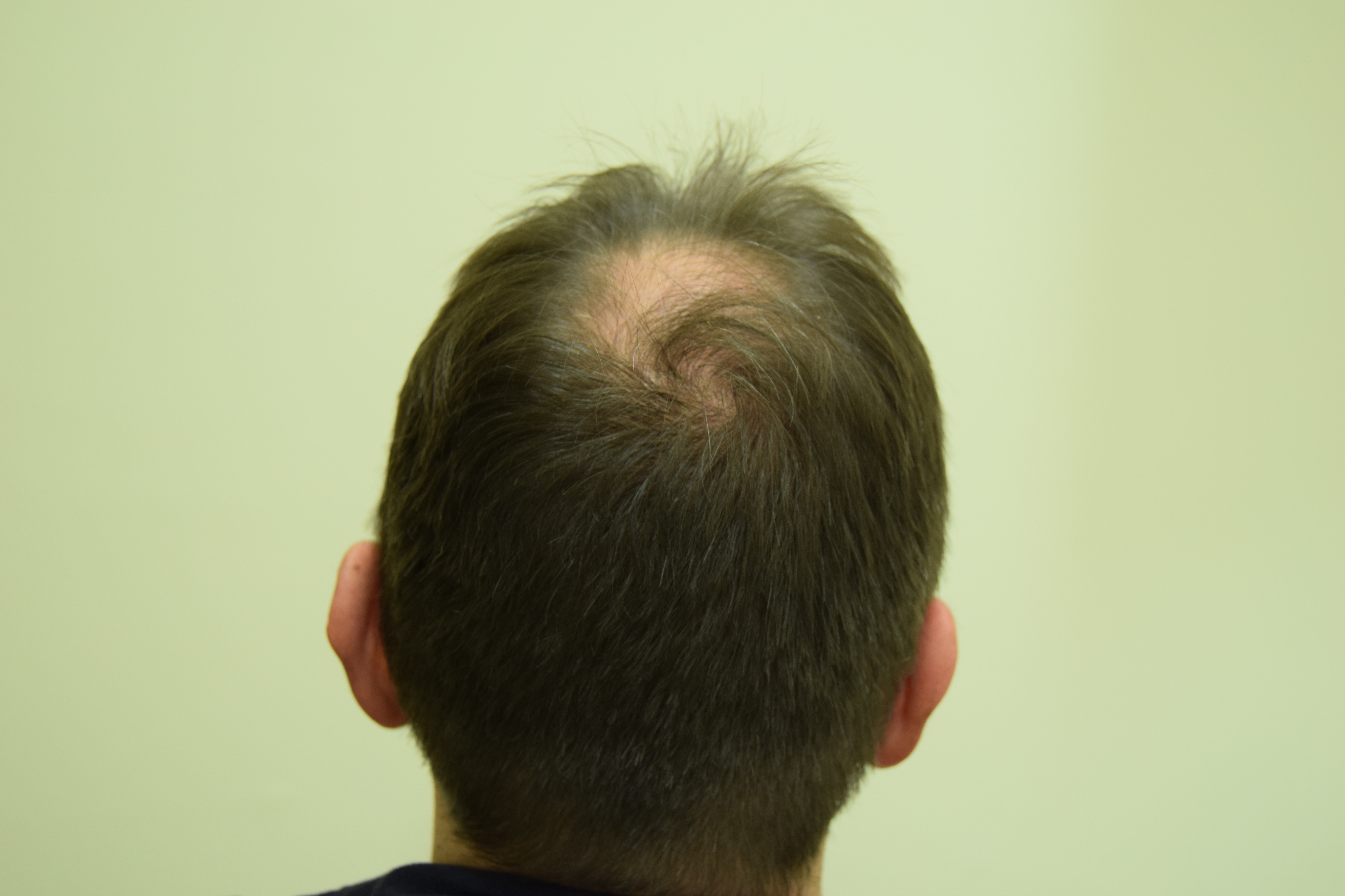 Diradamento del vertice Caduta capelli vertice uomo