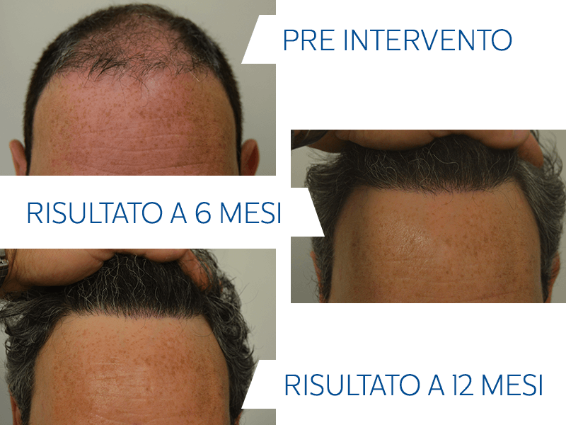 fermare il diradamento dei capelli Risultati Trapianto Smart Fue