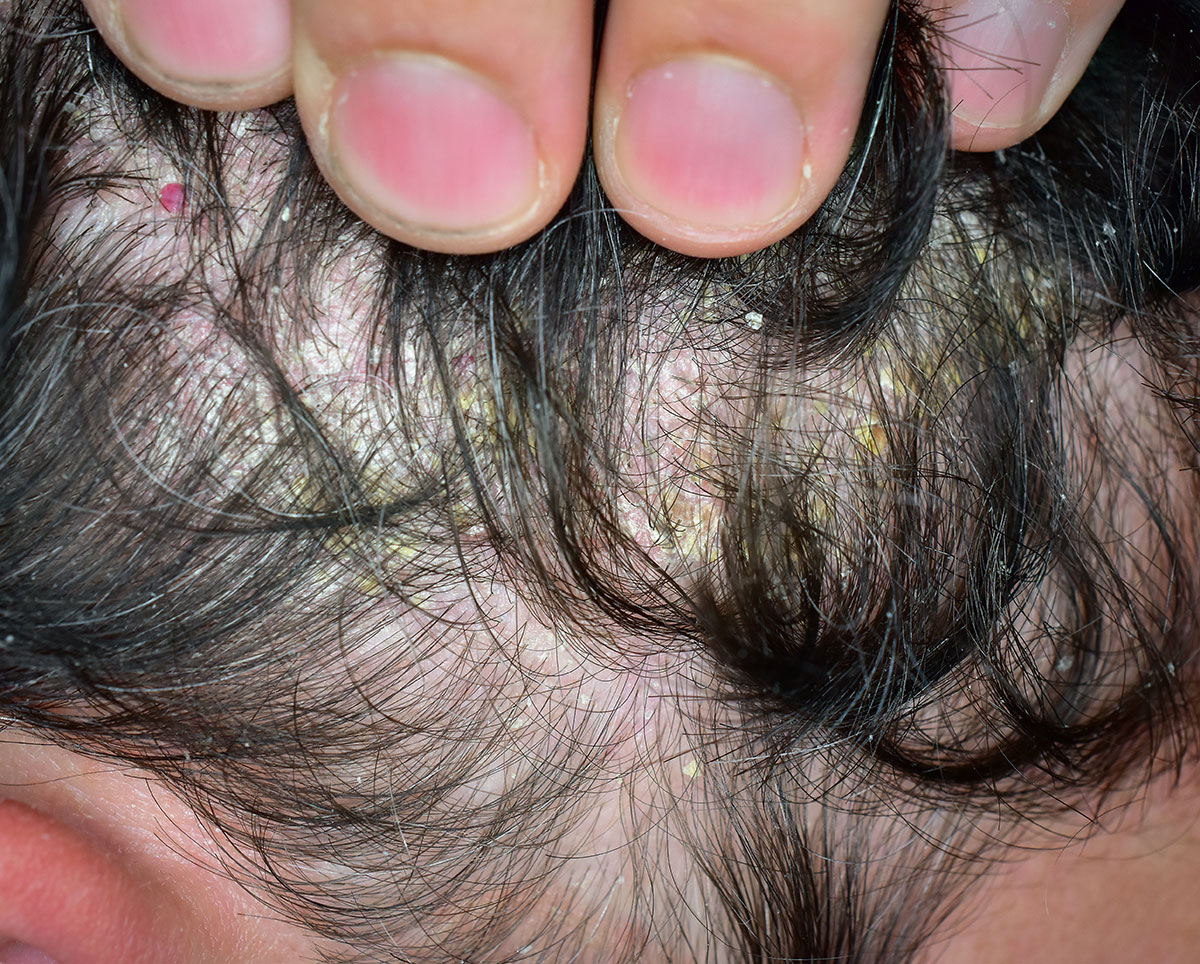 Come sapere se hai la seborrea seboorea dei capelli e forfora
